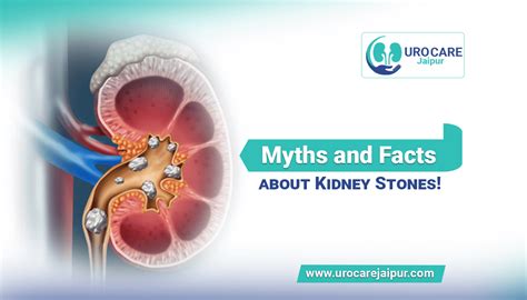 Why Does Tea Cause Kidney Stones: A Brew of Myths and Misconceptions